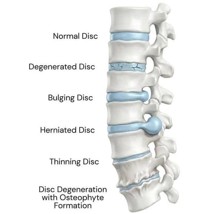 Understanding Subluxation: The Hidden Cause of Many Health Issues